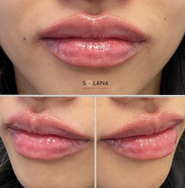 lip fillers downers grove il